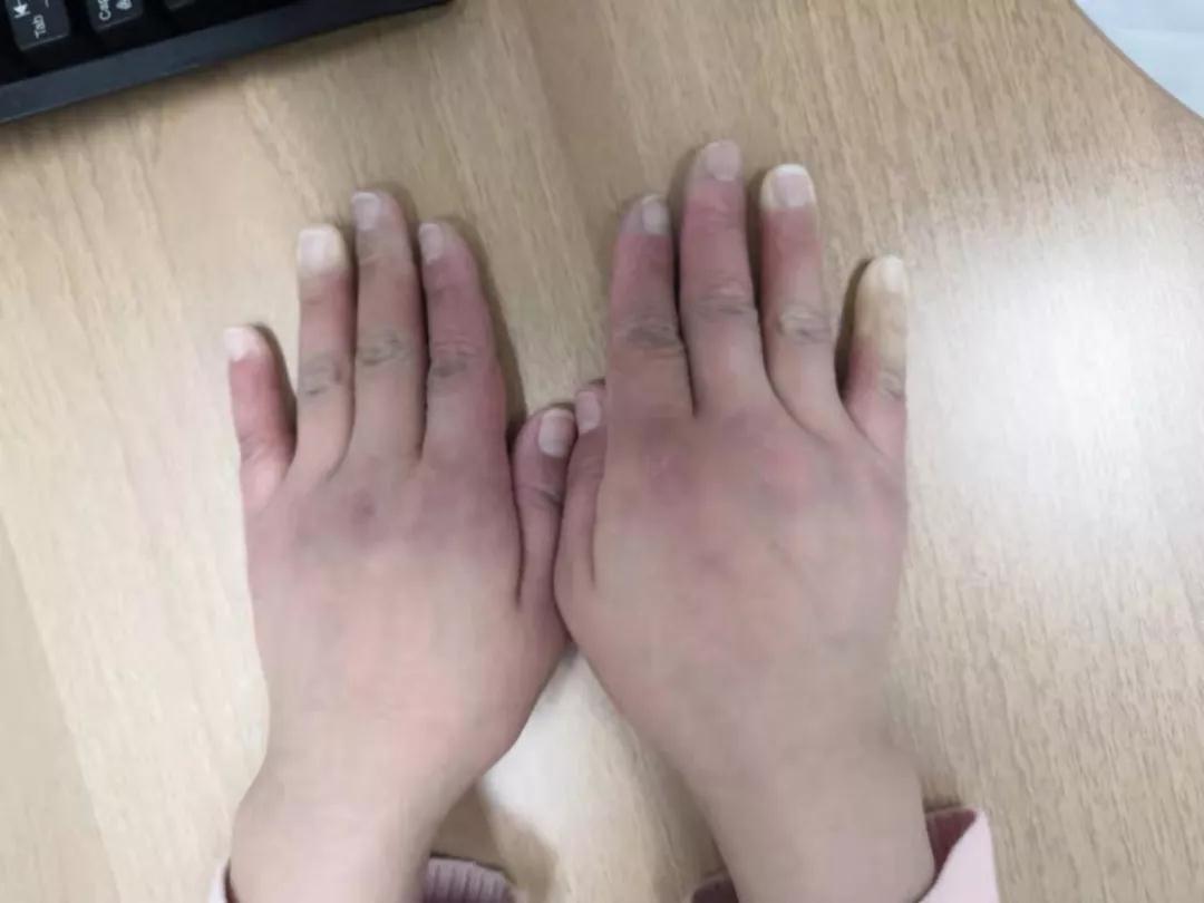 “手指、腳趾發(fā)白、發(fā)紫……”這些“小毛病”千萬別大意