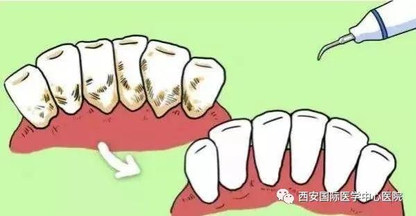 【科普】牙齒上的黃斑好難看，三招告訴你如何預(yù)防氟斑牙