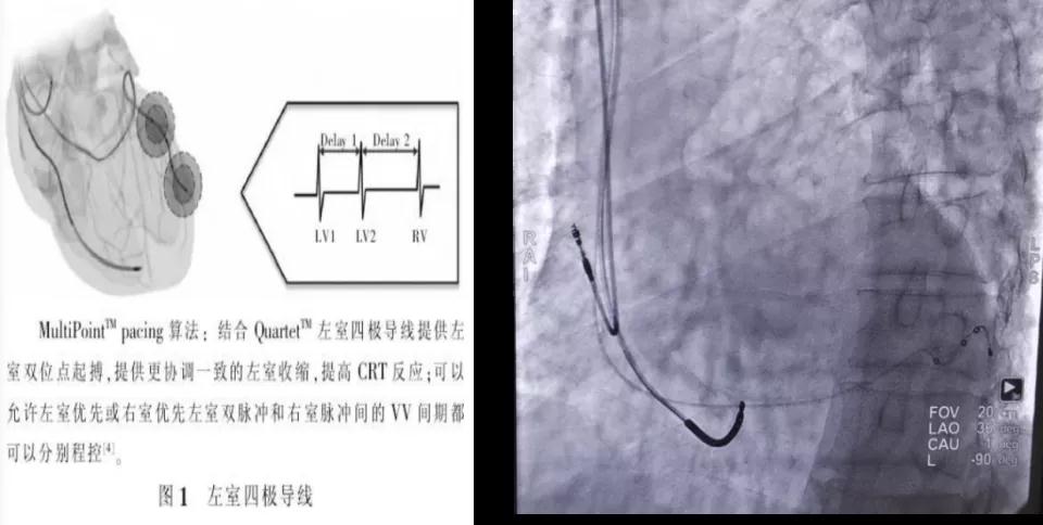 心臟病醫(yī)院心臟內科首例心臟再同步治療除顫器（MPP-D）植入成功