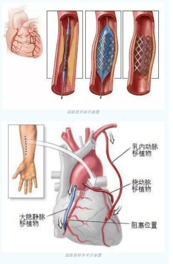 魚與熊掌不可兼得？冠脈雜交手術(shù)一站式解決問題