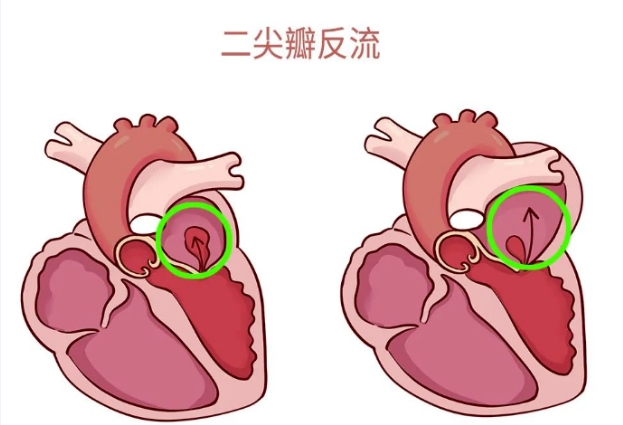 體檢報告里的心臟瓣膜返流，你讀懂了嗎？